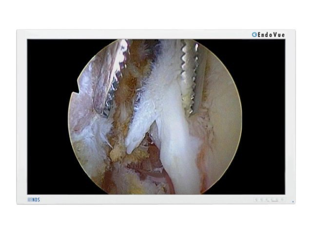 NDSsi EndoVue(R) 42” LED Surgical Display Monitor