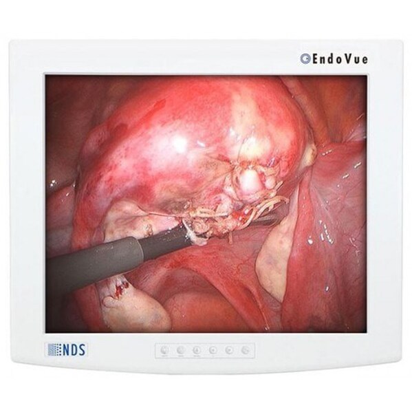 NDSSI EndoVue 19" LED Surgical Monitor