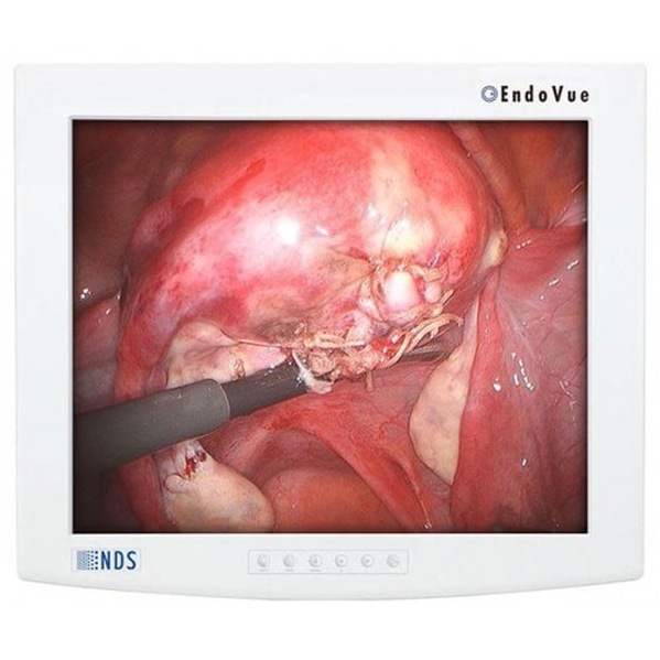 NDSSI EndoVue 21" LED Surgical Monitor