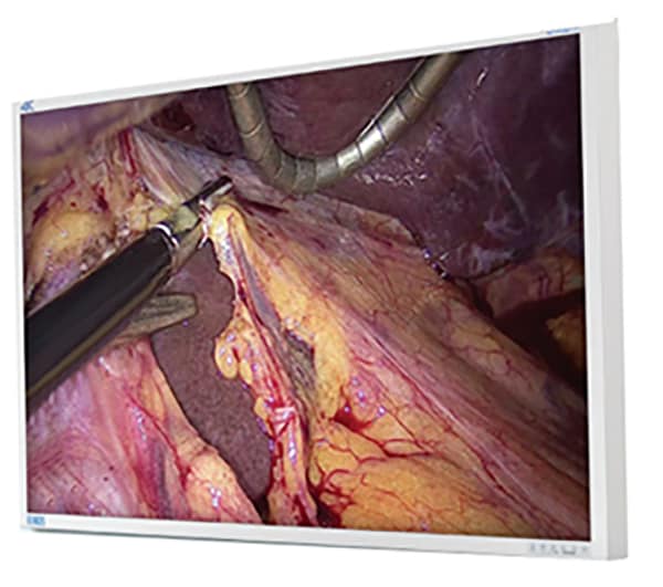 NDS Surgical Imaging EndoVue Plus 55" 4K Medical Grade Display